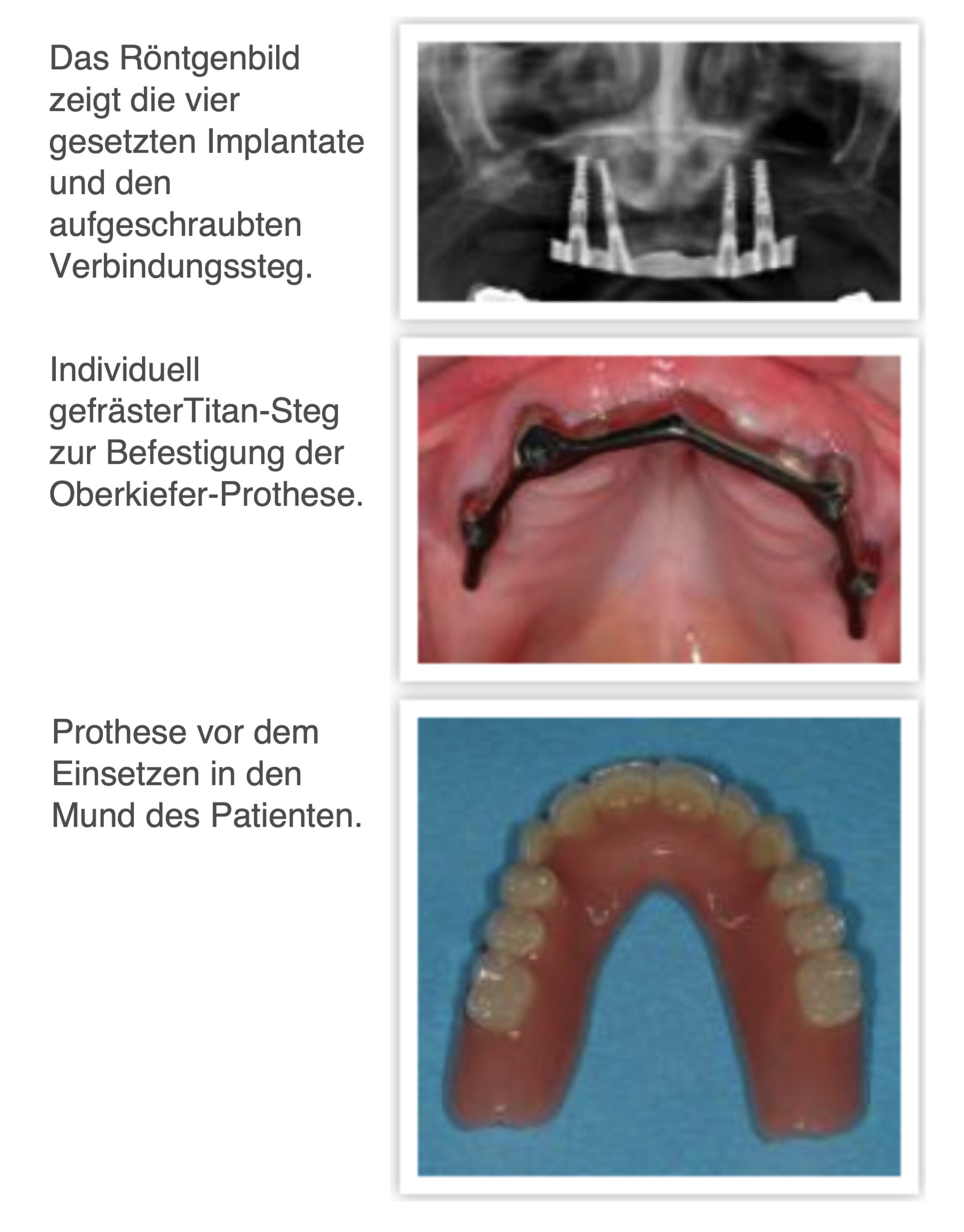 feste dritte Zähne