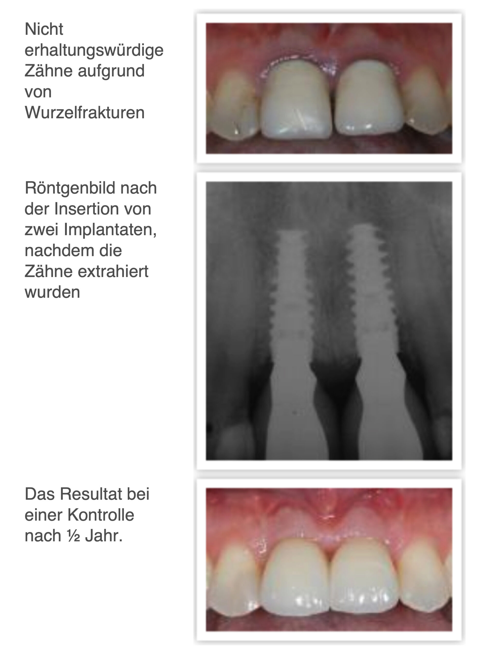 Implantat Krone